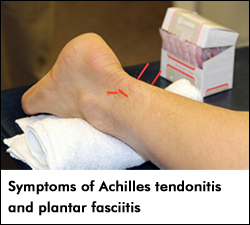 Symptoms of Achilles tendonitis and plantar fasciitis
