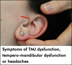 Symptoms of TMJ dysfunction, tempero-mandibular dysfunction or headaches